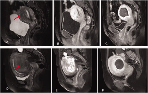 Figure 5. HIFU treatment for internal and external adenomyosis (red arrow heads). A&B. Pre-HIFU T2WI and contrast enhanced MRI showed an internal adenomyotic lesion located at the anterior wall of the uterus; C. A contrast enhanced MR image obtained 1 day after HIFU showed the internal adenomyotic lesion was ablated. The NPV ratio was 90%. D&E. Pre-HIFU T2WI and contrast enhanced MRI showed an external adenomyotic lesion located at the posterior wall of the uterus. Uterorectal adhesion was observed; F. C. A contrast enhanced MR image obtained 1 day after HIFU showed the enternal adenomyotic lesion was ablated without damaging the serosa of the uterus. The NPV ratio was 60%.