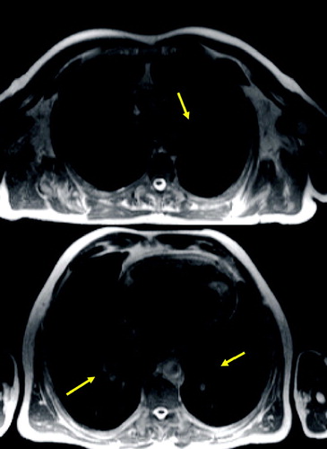 Figure 1 T2 weighted axial MR images (HASTE) showing bronchial wall thickening of left upper lobe and lower lobes (arrow).