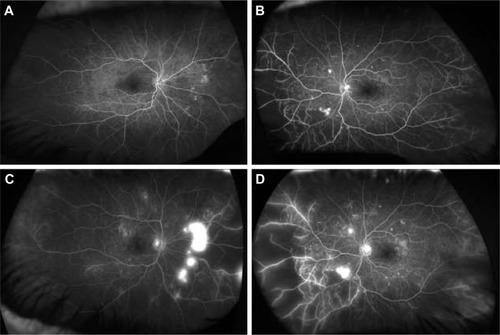 Figure 1 Ultra-wide-field fluorescein angiography (UWFA) of a 68-year-old male patient affected by proliferative diabetic retinopathy in both the eyes. Early phases of the right (A) and left (B) eyes. Late phases of the right (C) and left (D) eyes. In early angiographic phases, UWFA discloses hyperfluorescent dots in both the eyes suggestive of microaneurysms and broad peripheral and mid peripheral areas of capillary non-perfusion. In late frames, UWFA discloses peripheral perivascular and mild macular dye leakage, suggestive of blood–retina barrier disruption, and intense hyperfluorescence of retinal surface, indicative of epiretinal neovascularization in both the eyes.