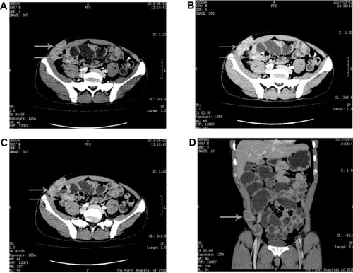 Figure 1 The preoperative abdominal CT images of the cecal cancer.