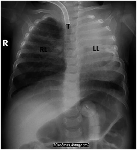 Figure 7. Plain film radiographs obtained in February 2021. Anatomical improvement of thorax compared to previous study. Trachea at midline, endotracheal tube in situ. Resolution of abdominal ascites.
