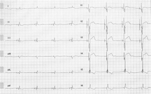 Figure 2 An electrocardiogram shows biventricular pacing after CRT-D implantation.