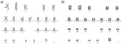 Figure 1. G-banding Karyotype. Mosaic karyotype with 90 metaphases with X chromosome monosomy (a) and 10 normal metaphases (b).