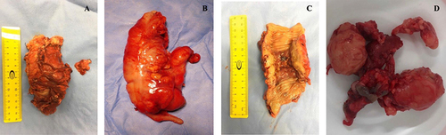 Figure 4 Macroscopic appearance of surgically (A) resected transverse fungal colon mass, (B) Resected cecal fungal colon mass, (C) resected transverse fungal colon mass, and (D) resected mesenteric fungating mass.
