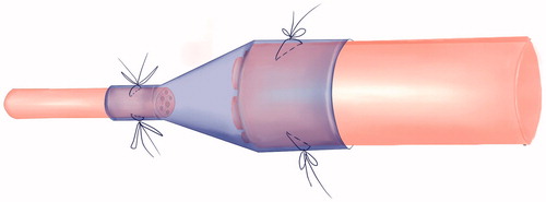 Figure 2. The cone conduit suture tubulization method for specific repair model of repairing thick nerve fibres with fine nerve fibres.