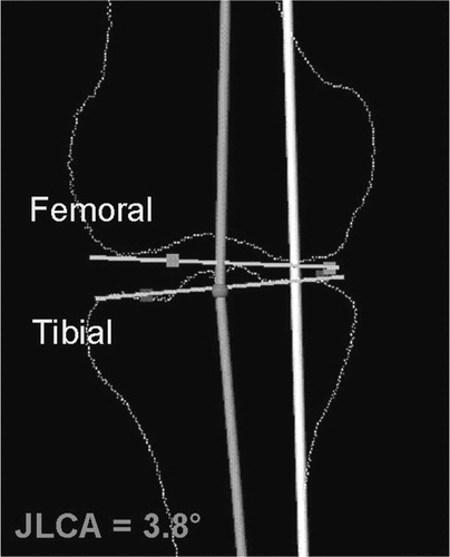 Figure 3. Femoral and tibial joint lines and JLCA. A biased JLCA value indicates that the deformity measured consists of not only a primary osseous deformity but also a secondary deformity resulting from lateral soft tissue laxity. In this case, the soft tissues need to be balanced. The normal range of JLCA lies between 0.7 and 2.4° according to Paley et al. Citation[34].