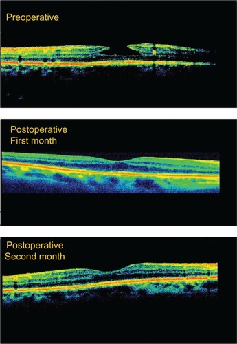 Figure 1 Typical optical coherence tomography image representative of successful lamellar macular hole surgery.