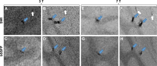 Figure 8 Ex vivo experiment with different numbers of cells, that is, ~100 (A, C, E, G) and ~1,000 (B, D, F, H), injected into the pig brain, respectively.Notes: Images (A–D) were acquired at 3 T, while images (E–H) were acquired at 7 T. Images (A, B, E, and F) in the first row are SWI images, while images (C, D, G, and H) in the second row are RMS combined phase-cycled bSSFP images. The blue arrows in images (A–H) show labeled cells, while the white arrows show false-positive detection of labeled cells.Abbreviations: bSSFP, balanced steady state free precession; SWI, weighted imaging.