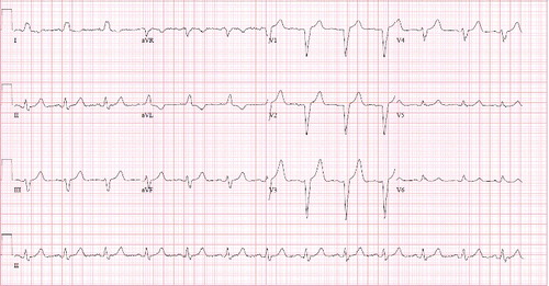 Figure 1. First formal ECG depicting left bundle branch block (done at 36 h post-ingestion).