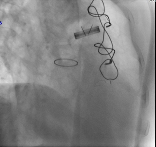 Figure 1 First fluoroscopy.