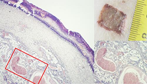 Figure 2 The wound crater center by the end of the 3rd day, DHB group. Abundant scab infiltration, tissue edema, and vessel plethora. Hematoxylin–eosin staining (Magnification: X40 and X100).