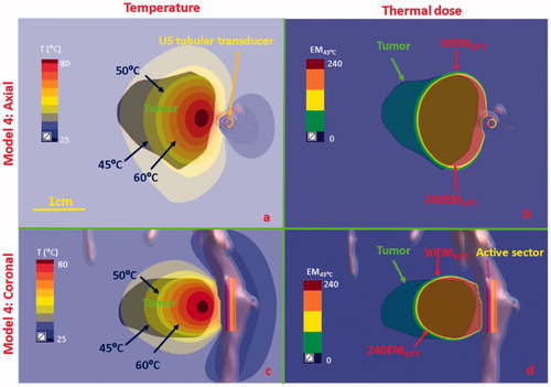 Figure 10. Temperature and thermal dose distributions for patient-specific Model 4 along the coronal (a and b) and axial planes (c and d) after 300 s sonication with an endobronchial tubular applicator (2 mm transducer OD × 10 mm, 150° active zone, 7 MHz, 30 W/cm2) applied to deliver thermal coagulation to the tumor in conjunction with lung flooding. The 2 cm diameter tumor volume is adjacent to and separated by approximately 5 mm of lung from the tertiary bronchial airway in deep lung. Temperature contours of 45 °C, 50 °C, and 60 °C are shown in (a) and (c), and dose contours of 30EM43˚C and 240EM43˚C are shown in (b) and (d). US: ultrasound.