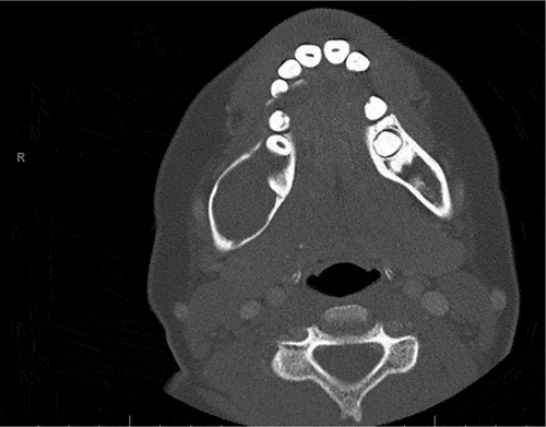 Figure 2. Axial CT image demonstrating the anterior-posterior dimension (approximately 4 cm) of an expansile, unilocular radiolucent lesion of the right posterior mandible. Note the significant asymmetry in buccal-lingual width compared to the contralateral side.