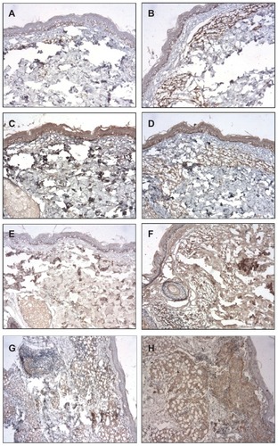 Figure 3 Photomicrograph of a skin biopsy. (A) Immunoreactivity for IL-12 in a case of MB leprosy before the BCG-id (NovoLink staining with hematoxylin counterstaining, ×100). (B) Immunoreactivity for IL-12 in a case of MB leprosy after the BCG-id (NovoLink staining with hematoxylin counterstaining, ×100). (C) Immunoreactivity for TGF-β in a case of MB leprosy before the BCG-id (NovoLink staining with hematoxylin counterstaining, ×100). (D) Immunoreactivity for TGF-β in a case of MB leprosy after the BCG-id (NovoLink staining with hematoxylin counterstaining, ×100). (E) Immunoreactivity for TNF-α in a case of MB leprosy before the BCG-id (NovoLink staining with hematoxylin counterstaining, ×100). (F) Immunoreactivity for TNF-α in a case of MB leprosy after the BCG-id (NovoLink staining with hematoxylin counterstaining, ×100). (G) Immunoreactivity for TNF-α in a case of PB leprosy before the BCG-id (NovoLink staining with hematoxylin counterstaining, ×100). (H) Immunoreactivity for TNF-α in a case of PB leprosy after the BCG-id (NovoLink staining with hematoxylin counterstaining, ×100).