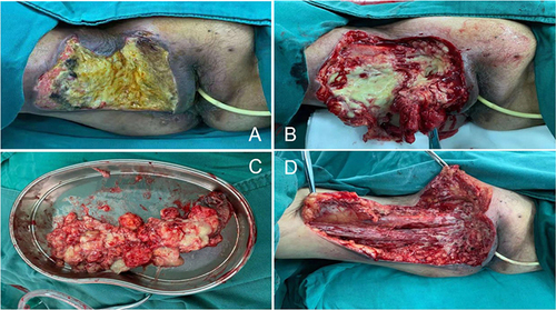 Figure 4 First Surgical Procedure: (A) Extensive fat necrosis with local necrosis; (B) liquefied fat and fascial necrosis; (C) Excised necrotic fat tissue; (D) Debridement deep into the muscle layer.