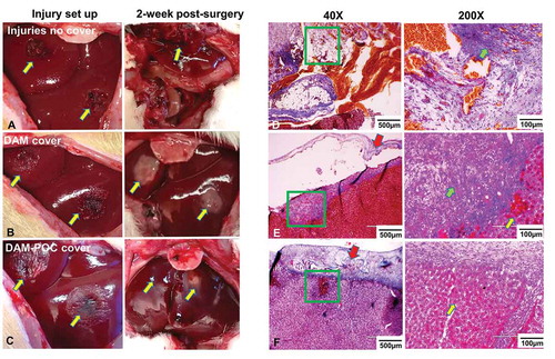 Figure 4. (a) Gross view of the liver injuries after setting up (left) and after 2-week repairing without any dressing covering (right) in the liver wound group; (b) gross view of liver injuries that were covered with DAM dressing (left) and after 2-week repairing (right) in the DAM group; (c) gross view of liver injuries that were covered with DAM-POC dressing (left) and after 2-week repairing (right) in the DAM-POC group. Masson’s trichrome staining of liver injuries after 2-week repairing in the (d) liver wound group, (e) DAM group, and (f) DAM-POC group. Liver injuries were indicated with arrows in A–C. Lower magnification (left) and higher magnification (right) of area in green rectangle were indicated in D–F. DAM and DAM-POC were indicated by red arrows in E and F. In E–G, inflammatory cell was indicated by the green arrow and the newborn hepatocyte was indicated by the yellow arrow