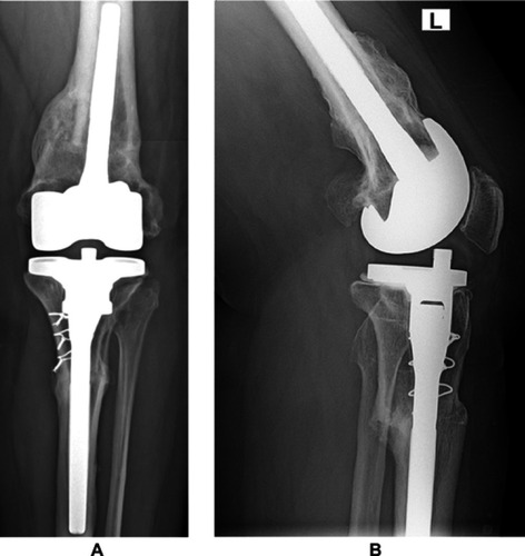 Figure 4 Postoperative radiograph taken at 5-year follow-up. (A) Anteroposterior view and (B) lateral view.