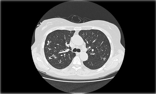 Fig. 1 CT chest showing multiple nodular lesions with cavitation.