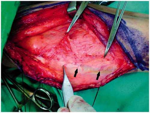 Figure 4. Intraoperative view of the flap harvesting for Case 2. Medial retraction of the rectus femoris muscle revealed atrophy and pale, yellowish, fat-like color of the vastus lateralis muscle that was affected by poliomyelitis. The diameter of the perforators (black arrow) appeared normal.
