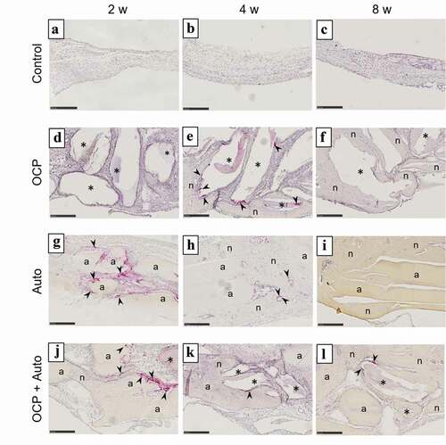 Figure 5. Images of rat calvarial defect regions in the sections with TRAP staining at 2 weeks (a, d, g, j), 4 weeks (b, e, h, k), and 8 weeks (c, f, i, l) of implantation of no materials (Control) (a–c), OCP (d–f), autogenous bone (g–i), and mixture of OCP and bone (j–l). Bars in the images represent 250 μm. Arrow heads indicate TRAP-positive cells; asterisks and ‘a’ indicate remaining OCP and autogenous bone; ‘n’ indicates newly formed bone, respectively