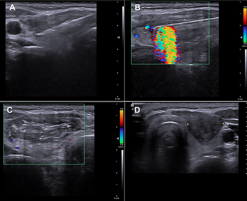 Figure 2 50-year-old woman with right thyroid nodule and pain who underwent radiofrequency ablation. (A) Axial sonographic view shows trans-isthmic approach of radiofrequency electrode. The moving-shot technique was used to ablate the nodule from unit to unit. (B) Axial sonographic view shows that the vascularities inside and around the nodules was found by using Doppler ultrasonography and ablated these as much as possible. (C) Entire nodule was filled with echogenic microbubble without any vascularities at end of ablation. (D) Cystic thyroid nodule reduces the volume after 1 month follow up.