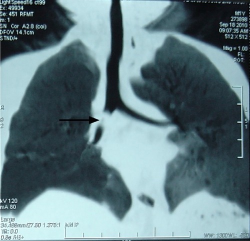 Figure 1 A representative case of TFB (arrow) detected by chest CT scan.