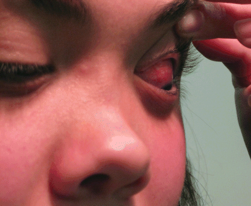 FIGURE 1  A 9 year-old girl presented with scleritis in her left eye