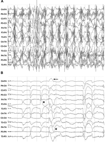 Figure 5. Normal rhythmical EEG recordings of a horse. (a) Masking EMG artefacts while chewing in an eating normal horse. Scale: 200 μV/division and 1 second/division. (b) The waves marked with * are eye movements and the smaller waves marked with ← are the result of blinking the eyelid. Scale: amplitude 50 μV/cm and 10 seconds/division.