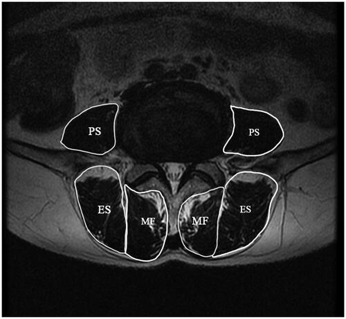 Figure 3. The example for measurement of CSA of multifidus (MF), psoas major (PS) and erector spinae(ES)on axial T2 weighted images.