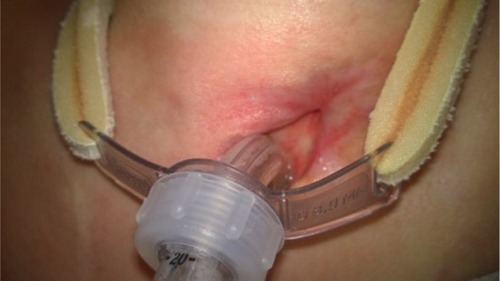 Figure 5 After local treatment.