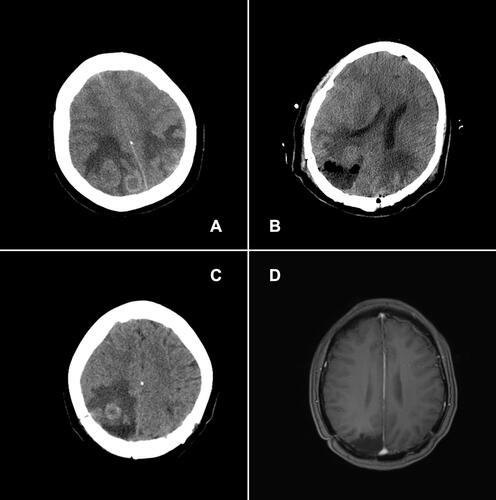 Figure 1 Preoperative and postoperative imaging findings of a patient with gestational trophoblastic neoplasia.