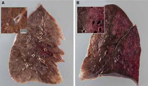 Figure 4. Gross lung findings observed during the postmortem examination of COVID‐19 human patient. (A) Appearance of lungs in a patient with COVID‐19. The thickened alveolar septae and congestive interstitial aspects are also visible in addition to the interstitial congestion (insert). (B) Severe and extensive suppurative bronchopneumonic infiltrates (insert) observed in a patient suffering from COVID‐19. Reproduced with modifications from Menter et al. (Citation2020) under Creative Commons Attribution (CC BY) licence.