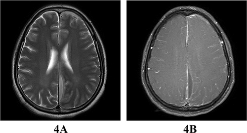 Figure 4 Cranial MR enhancement on July 28: There was meningeal thickening and abnormal enhancement, along with empyema adjacent to the cerebral falx and tentorium cerebelli. (A) T2 sequence showing a high signal bar on the left side of the cerebral falx, locally wrapped and considered to be empyema. (B) FLAIR sequence showing a low signal bar on the left side of the cerebral falx, locally wrapped.