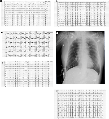 Figure 2 (a) The ECG showed sinus rhythm (HR:98 bpm), frequent atrial premature beats occurring in pairs, and some exhibiting a biphasic rhythm. (January 23, 2023 14:34:13); (b) the ECG showed sinus rhythm (HR 132 bpm), partial short-term ventricular tachycardia, and irregular intra-chamber conduction (January 30, 2023, 10:28:29); (c) the ECG showed rapid atrial fibrillation and ST segment depression (ST (I II III aVL aVF horizontal depression ≥ > 0.05 mV). (January 30, 2023 13:40:13); (d) a bedside chest X-ray revealed decreased lung transparency on the left and increased lung texture on January 30, 2023; “R”: right side of the patient; (e) the ECG showed rapid atrial fibrillation (HR: 177 bpm) with ST-T changes (ST-II III V4 V5 V6) horizontally inclined, upward and downward > 0.05 mV T (I) wave low and flat). (January 30, 2023 19:11:23); (f) the ECG showed sinus rhythm (HR: 87 bpm), frequent atrial premature beats occurring in pairs, and a T wave at a low level. (February 1, 2023, 16:17:58).