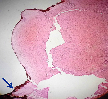 Figure 4 Histopathology of the uterus showing hemorrhage and fibrin on low power field. The ink (arrow) shows the margin of the serosal surface.