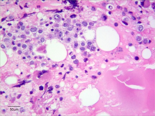 Figure 2 Bone marrow biopsy (hematoxylin and eosin 10×40).