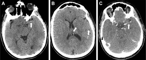 Figure 1 Cerebral CT scan showing spontaneous hyperdensity in the left middle cerebral artery proximal segment M1 (A), lentiform nucleus obscuration (B, arrow 1), loss of gray-white matter discrimination (B, arrow 2), and proximal occlusion of the left middle cerebral artery on CT angiography (C).