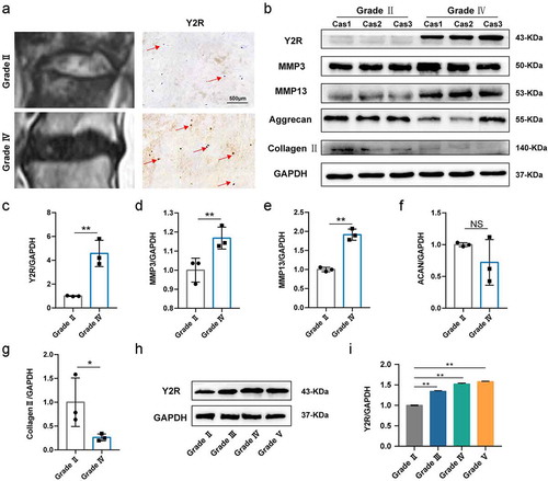 Figure 1 Expression of Y2R is increased in human degenerated discs. (a) Representative MRI images and immunohistochemistry for Y2R of the degenerated human discs between Pfirrmann grading II and IV; (b) Western blotting analysis for the expression of Y2R and IDD-related proteins in different samples (Normal group includes the former three ones, and the latter three ones belong to degeneration group). (c-g) The quantitative and statistical analysis of the western blot band (Y2R, MMP3, MMP13, Aggrecan, and Collagen type II); (h) Western blotting analysis for the expression of Y2R in human nucleus pulposus with different Pfirrmann grading; (i) The quantitative and statistical analysis of the western blot band (Y2R)