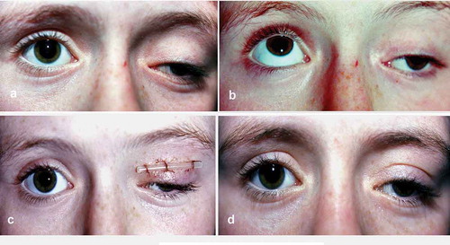 Figure 6. (a) Congenital ptosis and compensatory retraction of fellow upper lid in a child of 8. Compensatory retraction affecting contralateral upper and lower lids. Parents and child were as much concerned about the drooping eyelid as about the staring R eye; (b) total inaction of levator and sup rectus muscle on attempted up gaze. Absence of lid fold aggravates poor cosmesis. The L eye also remained half open in sleep; therefore, a deliberately small – 8 mm MT flap – resection was carried out to attain mild improvement of ptosis, but predominantly to elicit reduced retraction of both eyelids of the right eye; (c) 1 week post-op; and (d) final predicted cosmetic improvement enhanced by the lid fold.Reproduced from Br J Ophthalmol. Mehta HK, The contralateral upper eyelid in ptosis: some observations pertinent to ptosis corrective surgery, 63(2):120–124. Copyright 1979, with permission from the BMJ Publishing Group.