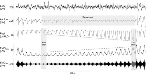 Figure 3 Example of robust genioglossus muscle responsiveness and restoration of airflow without cortical arousal.