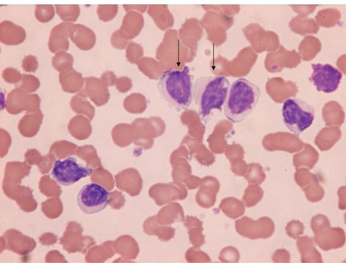 Figure 2 Atypical hairy cell lymphocytes (arrows) seen in peripheral blood.