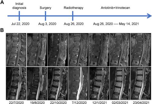 Figure 3 Timeline of treatment and MRI responses. (A) Timeline of the patient’s treatment. (B) MRI images of the patient at different times.