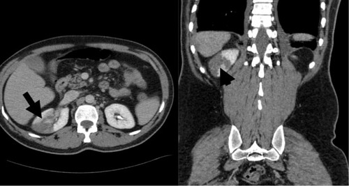 Figure 1 Peripheral diminished density without enhancement in right kidney.