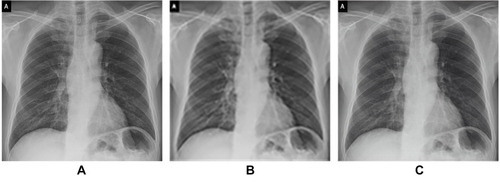 Figure 11 GARCD also has the potential to be applied to other types of medical imaging, such as X-ray (A is raw data, B is low-quality image, C is generated high-quality images).