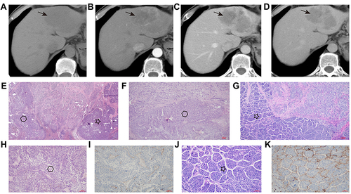 Figure 2 Example of a patient with tumor cells arranged by macrotrabecular or macrotrabecular-massive appearance (cHCC-CLC-Intermediate cells subtype). (A–D). contrast‐ enhanced CT images. (E–H and J). Hematein and Eosin staining. (F and H). macrotrabecular-massive permutation (Display full size), (G and J). vessels that encapsulate tumor clusters (VETC) pattern (Display full size). (I and K). present outcome of CK34 in those two arrangements.