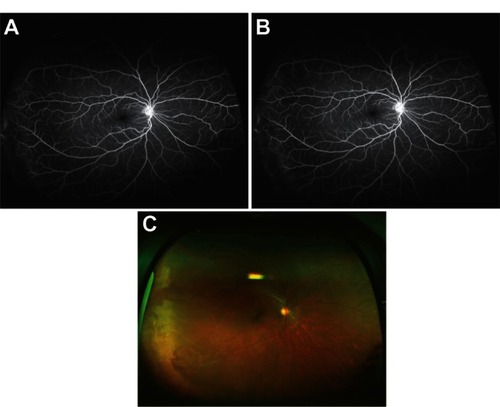Figure 5 (A and B) Ultra-widefield fluorescein angiography pattern three. (C) Color photo corresponding to Figure 5A and B.