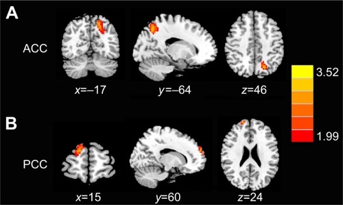 Figure 3 Aberrant FC of the (A) ACC and (B) PCC in tinnitus patients compared with healthy controls.