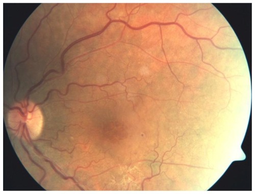 Figure 1 Fundus photograph of the left eye showing a tortuous retinal vein with a few retinal hemorrhages in the inferotemporal quadrant and macular edema.