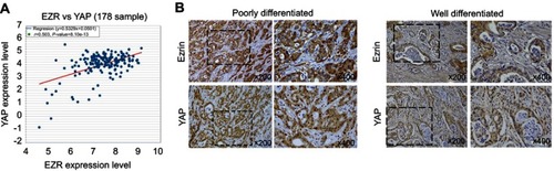 Figure 7 Expression of Ezrin and expression of YAP are statistically related in pancreatic cancer tissues.Note: (A) Correlation between mRNA expression of Ezrin and YAP in 178 samples of pancreatic cancer patients (obtained from the Starbase dataset). (B) Microscopic images of immunohistochemical staining of Ezrin and YAP in well-differentiated and poorly differentiated pancreatic cancer tissues.