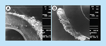 Figure 10.  Biofilm on urethral stents.Scanning electron microscopic picture of a developing biofilm on urethral stents that is lying completely within the urinary tract.Reproduced with kind permission from [Citation94] © Springer Science and Business Media (2006).